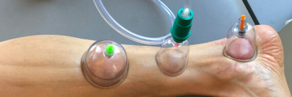 Cupping therapy on a patient's leg to enhance fascial glide and reduce pain.