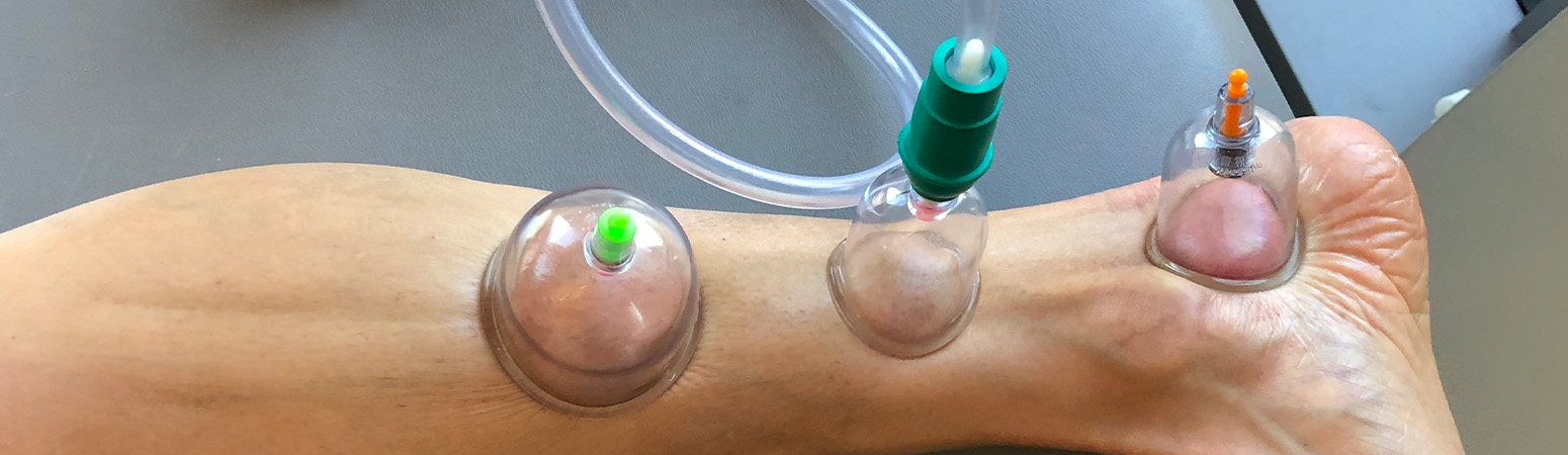 Cupping therapy on a patient's leg to enhance fascial glide and reduce pain.