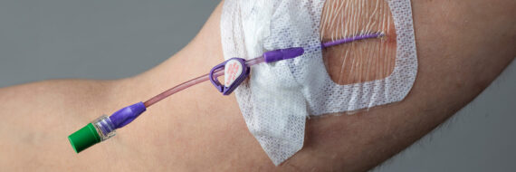 Close-up of a secured catheter line in a patient's arm, prepared for PICC line removal.